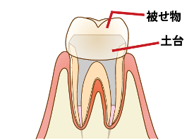 奥歯の差し歯はどう治すの 差し歯 かぶせ物 の特徴と種類について 歯科コラム 大垣市の歯医者 カルナデンタルクリニック