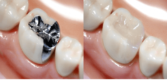 奥歯の銀歯を白くしたい 見た目をキレイに 体に優しい治療方法のご紹介 歯科コラム 大垣市の歯医者 カルナデンタルクリニック